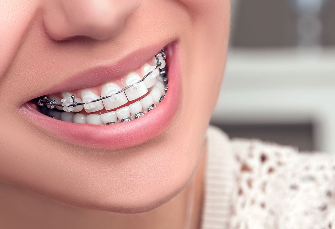 Clear Braces, Tooth-Colored Brackets in Milwaukee WI, Beloit WI, and  Roscoe IL